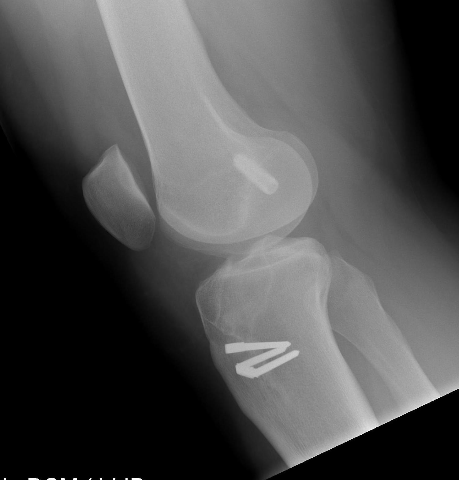 ACL BPTB Allograft Lateral